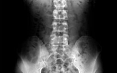 骨の歪みの多くは、長い年月で起こります。