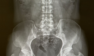 骨の歪みの多くは、長い年月で起こります。